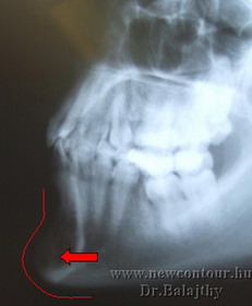 arcplasztika állkisebbítés röntgen
