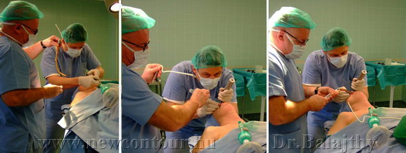 plasztikai sebészet érzéstelenítés műtét 1